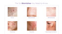 The Six Types of Skin Blemishes & What They Mean